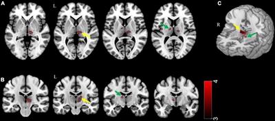 Gray Matter Volume of <mark class="highlighted">Thalamic Nuclei</mark> in Traumatized North Korean Refugees